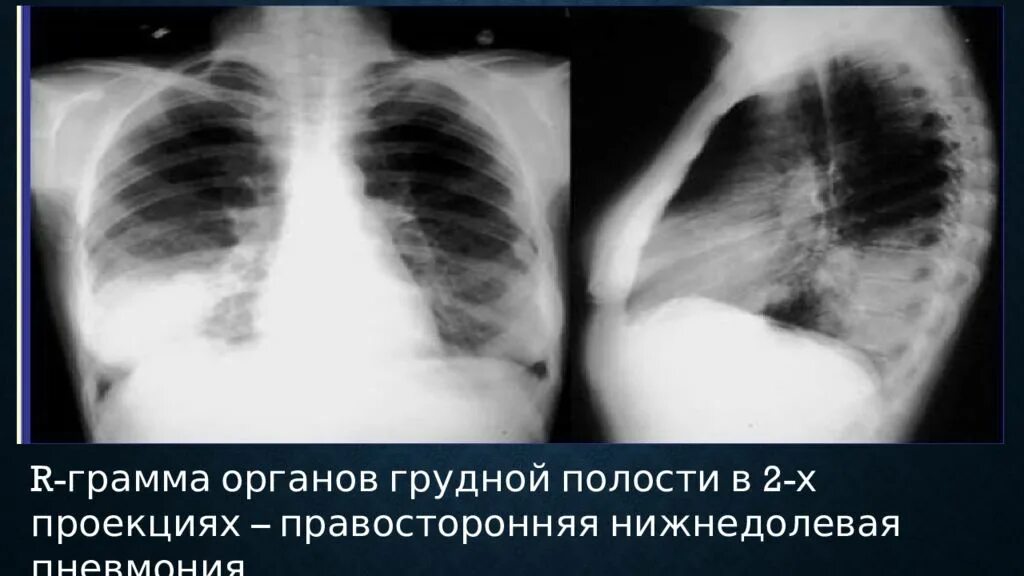 Пневмония в правой нижней доле. Нижнедолевая очаговая пневмония рентген. Правосторонняя нижнедолевая крупозная пневмония рентген. Внебольничная нижнедолевая пневмония рентген. Правосторонняя нижнедолевая пневмония рентген.