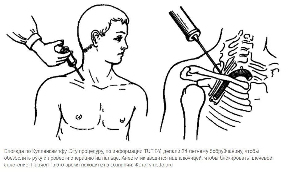 Блокада в шею. Блокада плечевого сплетения по Куленкампфу. Надключичная блокада плечевого сплетения. Проводниковая анестезия плечевого сплетения по Куленкампфу. Блокада плечевого сплетения подключичный доступ.