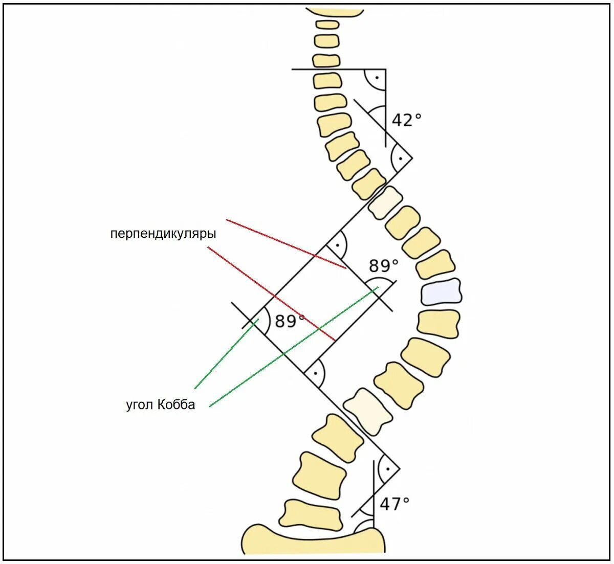 Угол Кобба степени сколиоза. Угол сколиоза по методу Кобба. Угол Кобба позвоночника кифоз. Метод Кобба сколиоз степени. Угол кобба
