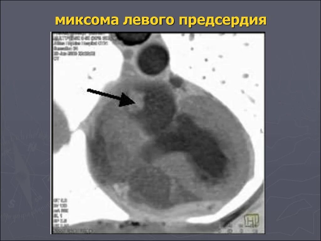 Образование левого предсердия. Опухоль сердца миксома. Миксома левого предсердия.