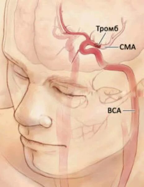Сосуды на лбу. Эмболия сосудов головного мозга. Эмболия мозговых артерий. Эмболия церебральных артерий. Тромб в сосуде головного мозга.