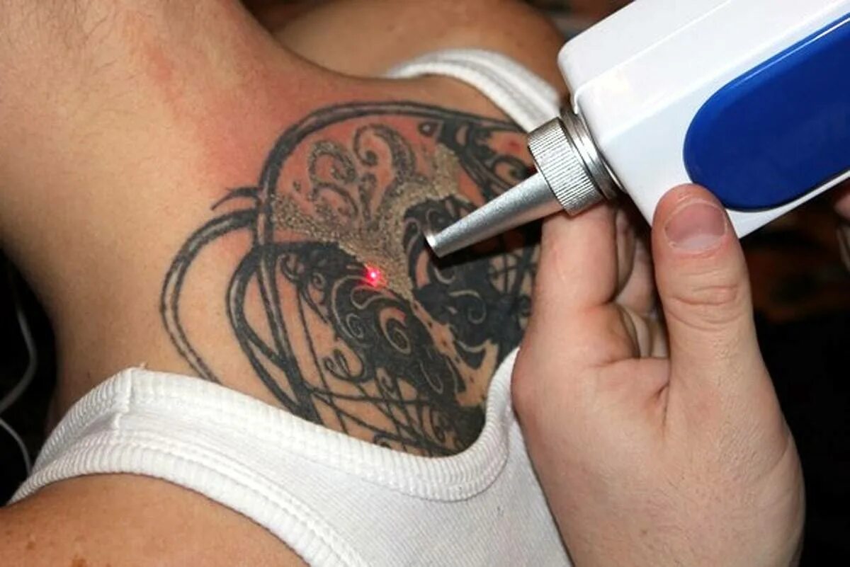 Сведение тату неодимовым лазером. Можно вывести татуировку