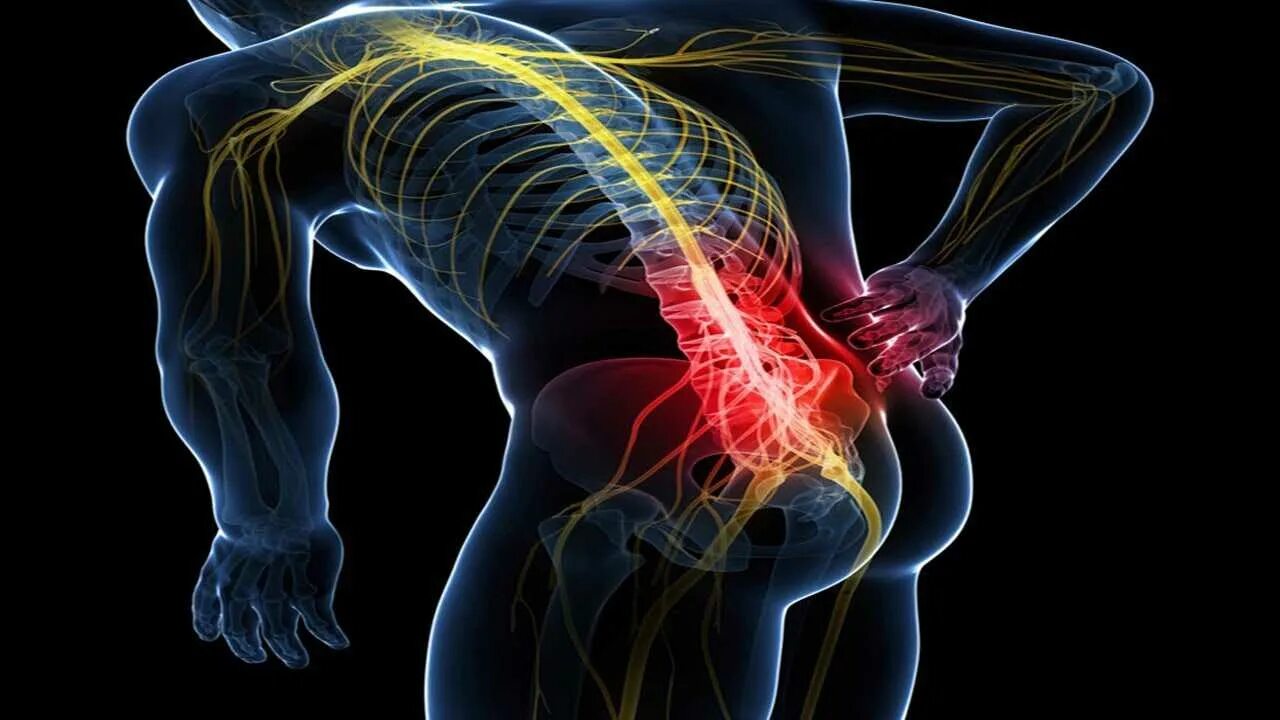 Седалищный нерв (sciatic nerve)? 011. Плексит пояснично крестцового отдела. Радикулит седалищный нерв в пояснице. Воспаление седалищного нерва на рентгене.