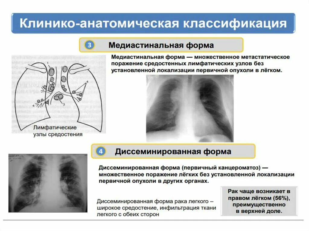 Периферическая опухоль верхней доли правого легкого. Опухоль верхушки правого легкого. Опухоль левого легкого. Образование верхней доли правого легкого. Периферическая опухоль верхней доли правого легкого.