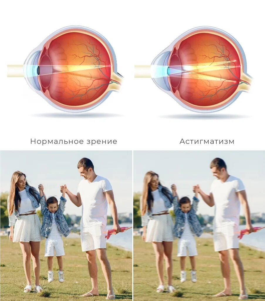 1 это нормальное зрение. Астигматизм. Астигматизм глаз. Астигматизм и близорукость. Что такое астигматизм зрения.