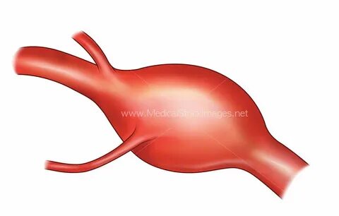 Aneurysm перевод