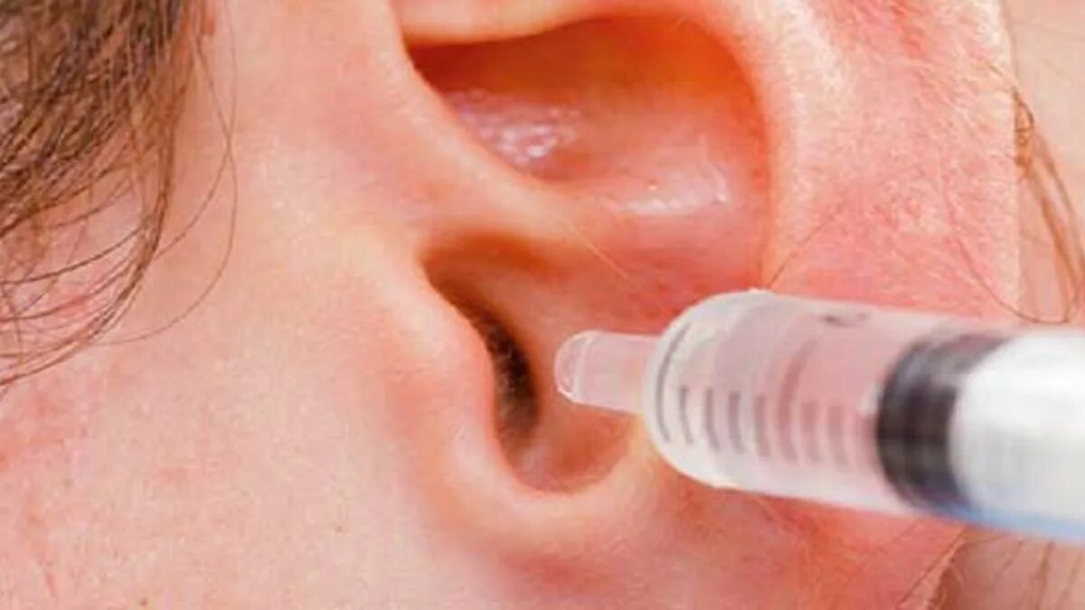 Как промыть уши самому в домашних условиях. Промывание ушных пробок. Промывание ушей от серных пробок. Шприц для вымывания пробок из ушей.