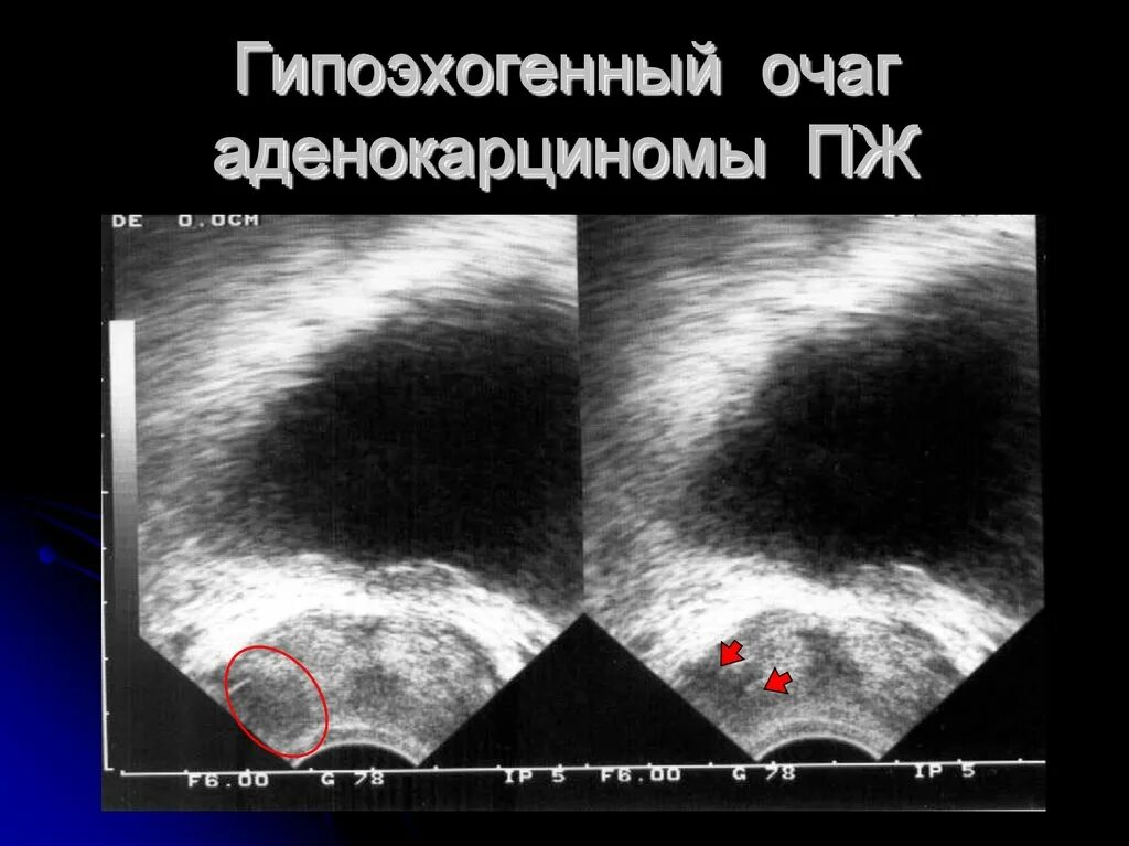 Узел в простате. Гипоэхогенные образования. Гипоэхогенное образование в предстательной железе. Образования предстательной железы на УЗИ.