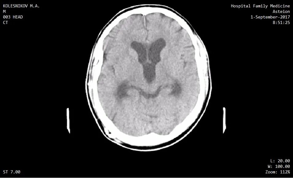 Операция гидроцефалия мозга. Гидроцефалия шунтирование. Шунт головного мозга при гидроцефалии. Наружная гидроцефалия на кт.