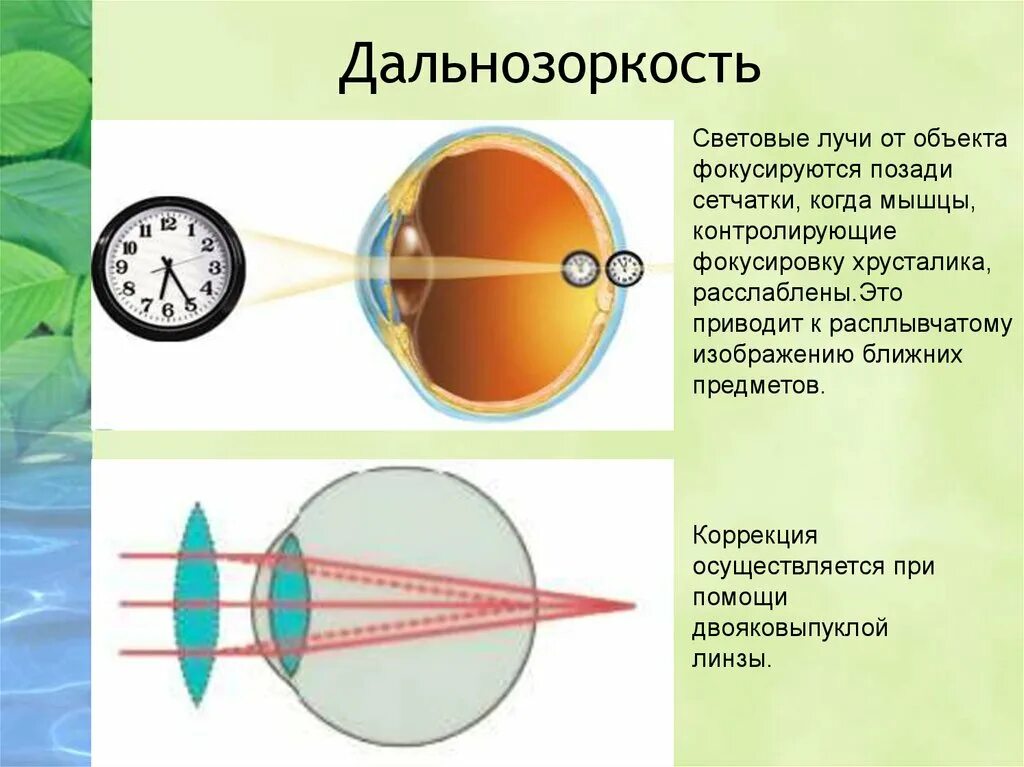 Дальнозоркость это когда. Дальнозоркость. Строение глаза дальнозоркость. Дальнозоркость (гиперметропия). Двояковыпуклая линза для дальнозоркости.