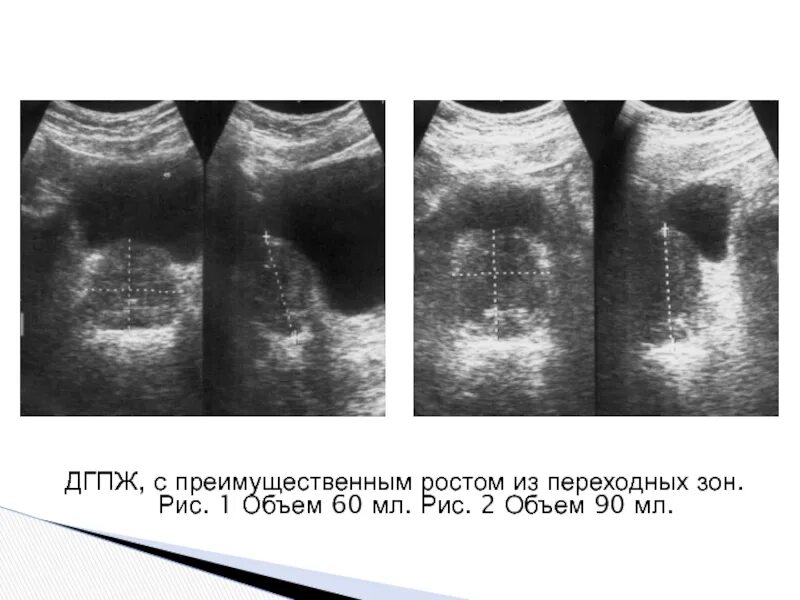 УЗИ доброкачественная гиперплазия предстательной железы. Аденома предстательной железы на УЗИ. Аденома предстат железы УЗИ. ДГПЖ на УЗИ предстательной железы. Гиперплазия предстательной железы 1