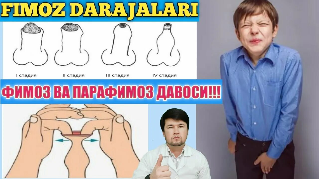 Что такое парафимоз. Парафимоз у детей.