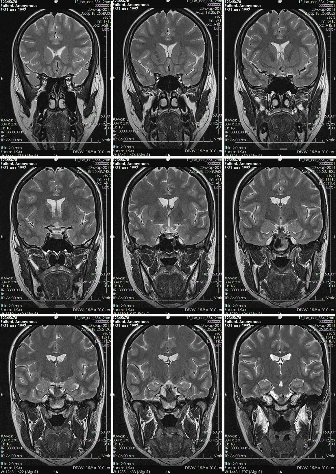 Мрт головного мозга Axial норма. Мрт магнитно-резонансная томография головного мозга. Мрт головного мозга фронтальная проекция. Мрт картирование головного мозга.