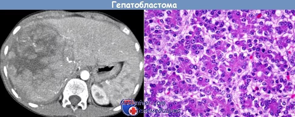 Метастазы в яичках