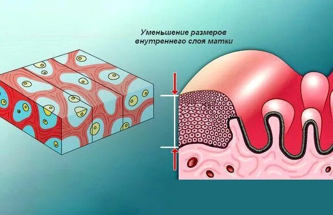 Атрофическая эндометрия. Атрофичный эндометрий. Атрофия эндометрия гистология.