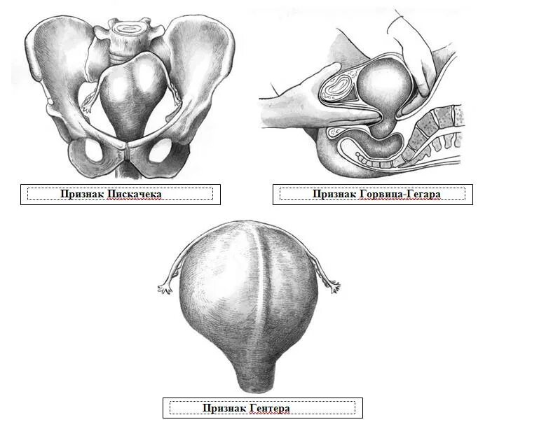 Симптомы пискачека гентера. Послеродовый эндометрит узи. Метод пискачека в акушерстве. Размеры матки в норме по узи. Вдм по неделям беременности.