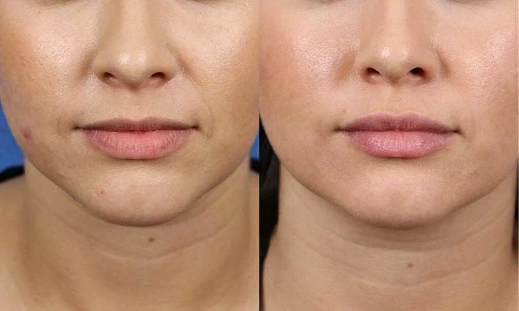 Уменьшение удаление. Уменьшение удаление. Рецессия десны лоскутная операция. Уменьшение удаление. Скулы филлерами.