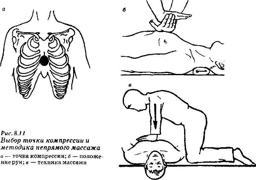 Непрямой массаж сердца точка компрессии. Схема проведения непрямого массажа сердца. Точка компрессии грудной клетки при сердечно легочной реанимации. Точка компрессии при СЛР.