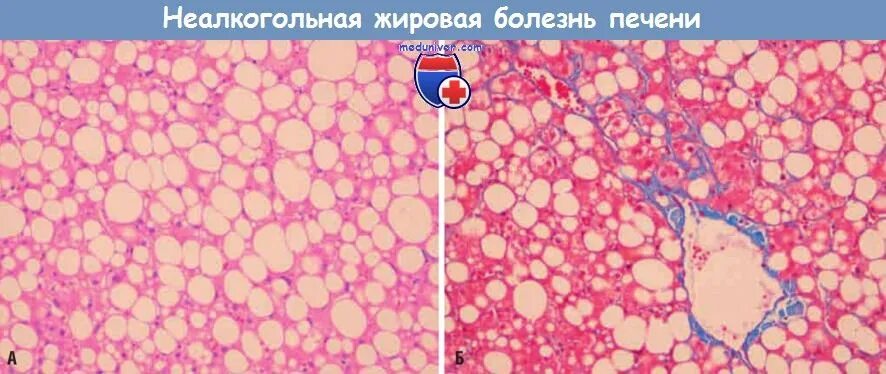 Печень больная жировой. Неалкогольная жировая болезнь печени гистология. Жировой гепатоз печени гистология. Неалкогольной дистрофии печени. Жировая дистрофия печени.