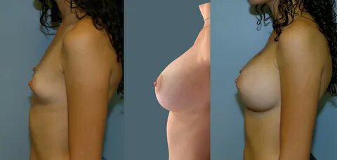 Should You Find A Plastic Surgeon with 3D Imaging for Breast Augmentation? 