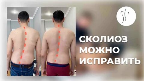 Сколиоз болит нога