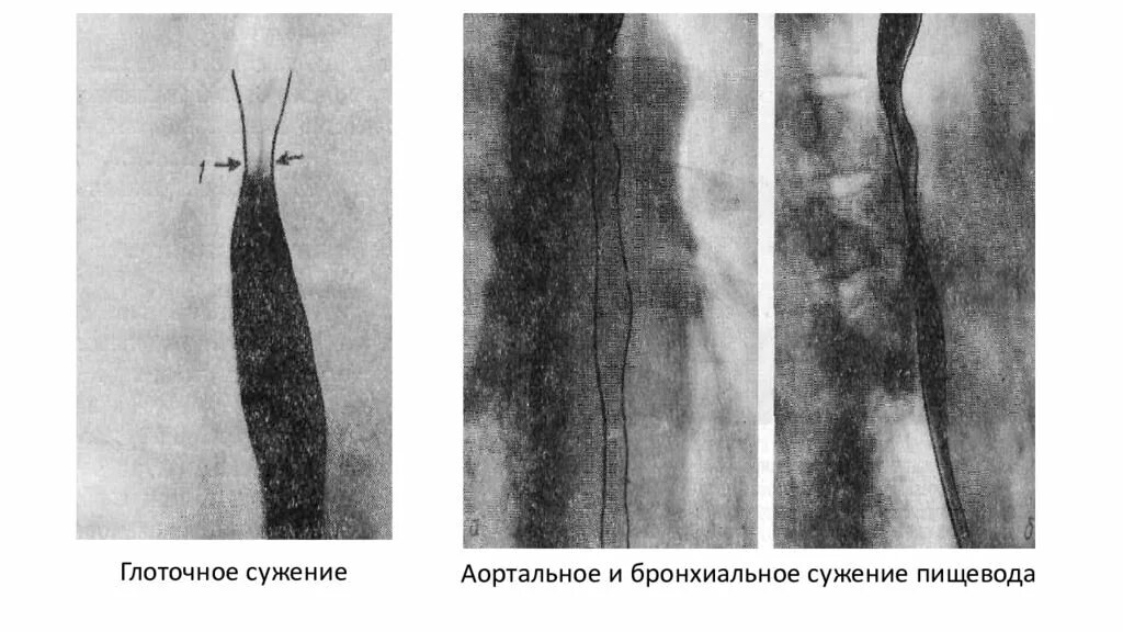 Пептическая стриктура пищевода. Рубцовое сужение пищевода бужирование. Аортальное сужение пищевода. Скопия пищевода