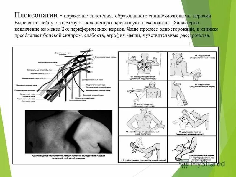 плексопатия плечевого сплетения мкб. травматический плексит плечевого сплетения дюшенна-эрба. травматический плексит плечевого сплетения дюшенна-эрба. плексопатия плечевого сплетения симптомы. плечевая плексопатия симптомы.