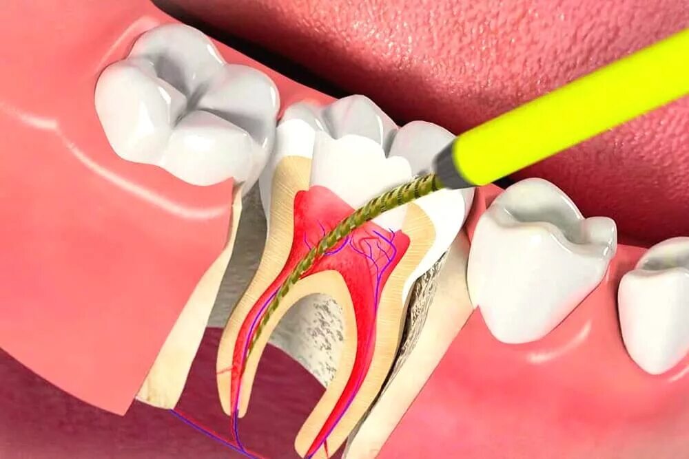 4 Канальный пульпит зуба. Двухканальный пульпит. Пульпит пломбировка каналов. Осложнения лечения пульпита