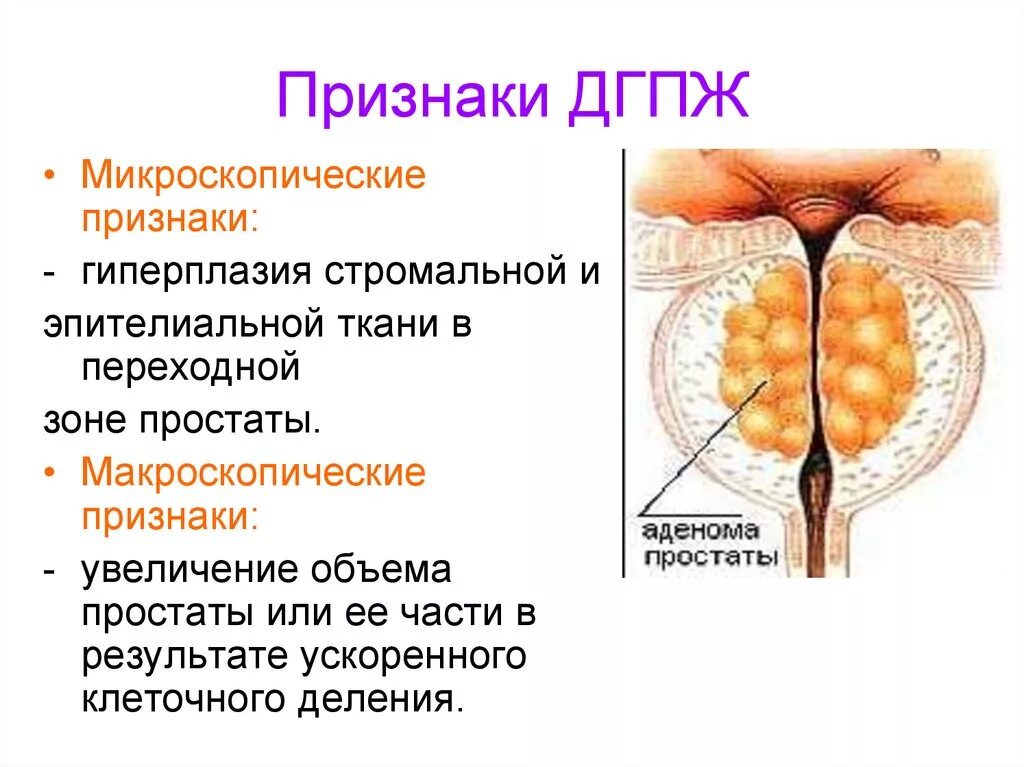 Доброкачественная гипоплазия предстательной железы. ДГПЖ предстательной железы что это такое. Микроскопические формы гиперплазии предстательной железы.