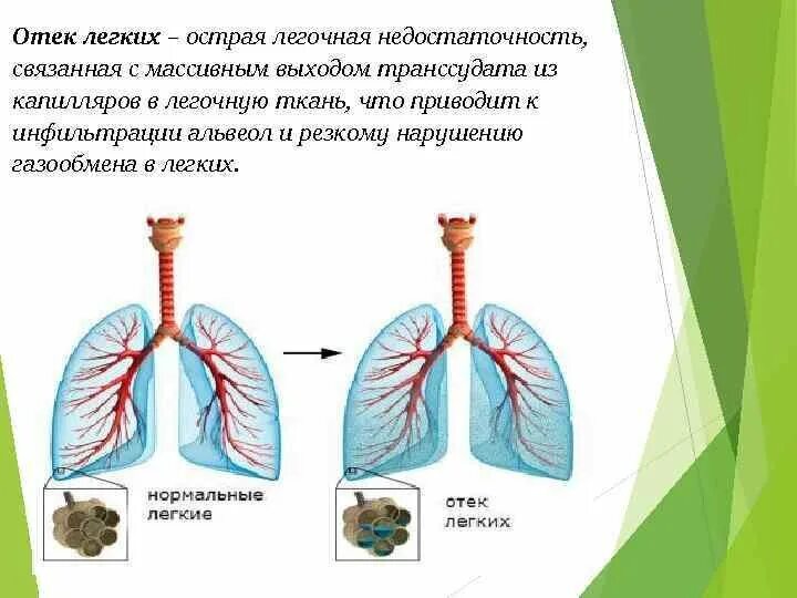 Кашель отек легких. Отек легких возникает вследствие:.