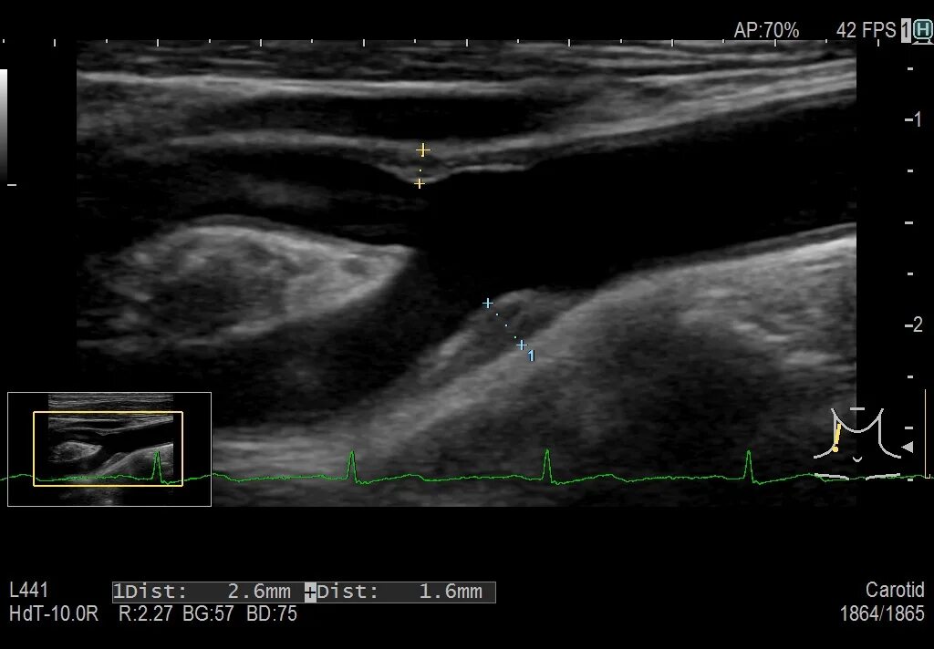 Узи крылова. Атеросклероз сонных артерий УЗИ. Стеноз сонных артерий на УЗИ. Бифуркация Оса на УЗИ. Бляшка в сонной артерии УЗИ снимок.
