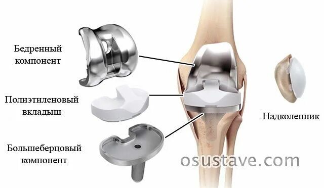 Эндопротез коленного сустава Columbus. Тотальное эндопротезирование коленного сустава схема операции. Эндопротез коленного сустава части. ТЭП эндопротезирование коленного сустава.