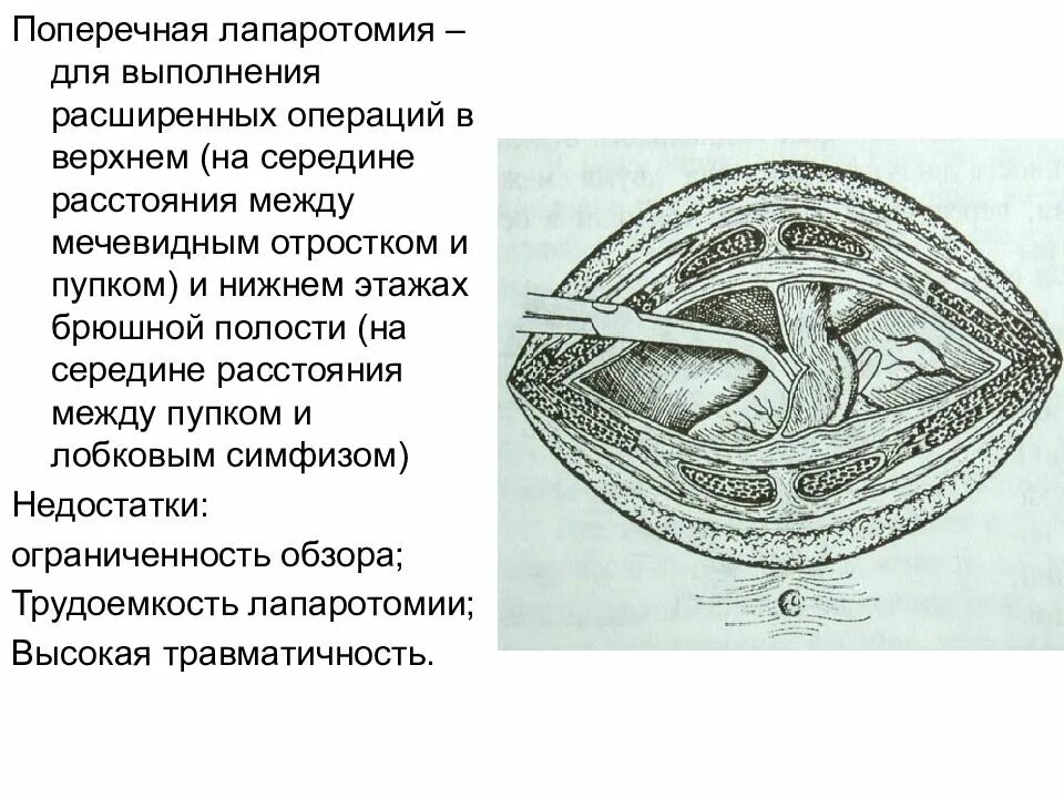 Лапаротомия что это такое простыми словами. Поперечные разрезы лапаротомия. Поперечная лапаротоми. Верхняя срединная лапаротомия. Верхняя поперечная лапаротомия.