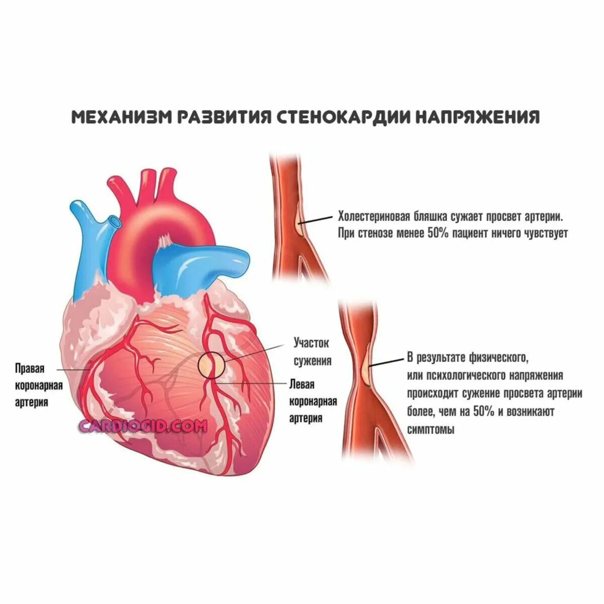Алгоритм неотложной доврачебной помощи при приступе стенокардии. Стабильная стенокардия напряжения клиника. Клиническа якарьина стенокардии. Ишемическая болезнь сердца презентация. Оказание первой доврачебной помощи при стенокардии.