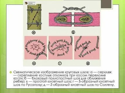 Круговой шов