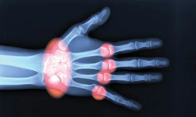 Артрит у детей диагностика. Дифференциальный диагноз ревматический артрит. Артрит у детей диагностика. Ревматический артрит клиника. Ювенильный ревматоидный артрит диагноз.