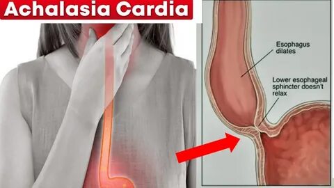 Ст кардия