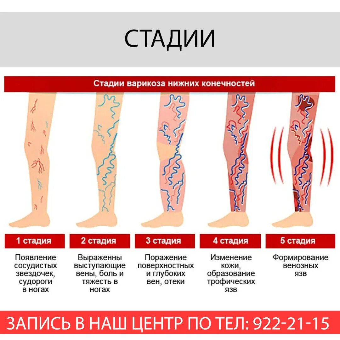 Варикозное расширение вен. Варикоз нижних конечностей. Варикозная болезнь нижних конечностей степени.