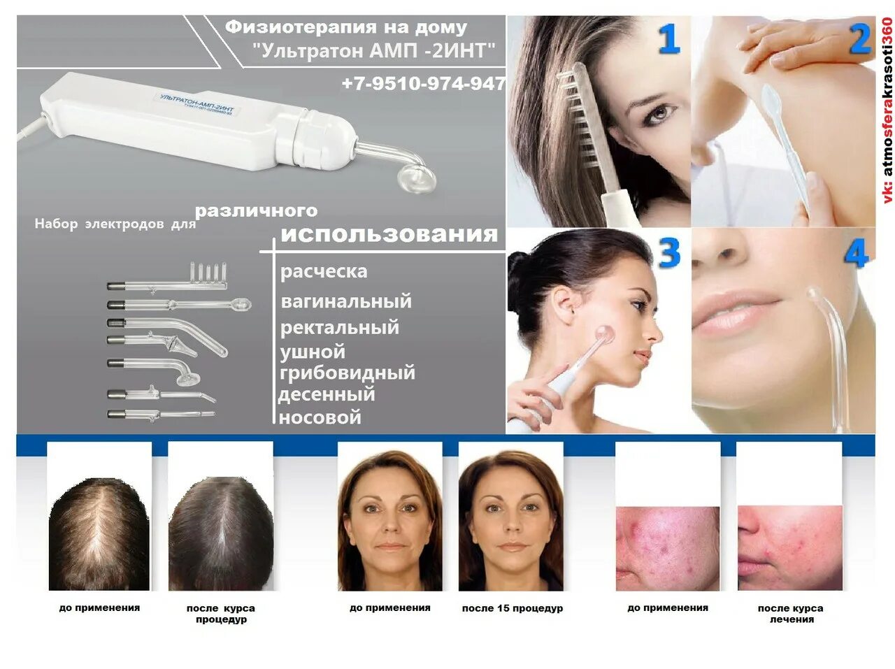 Дарсонваль: эффективное лечение от прыщей и угрей