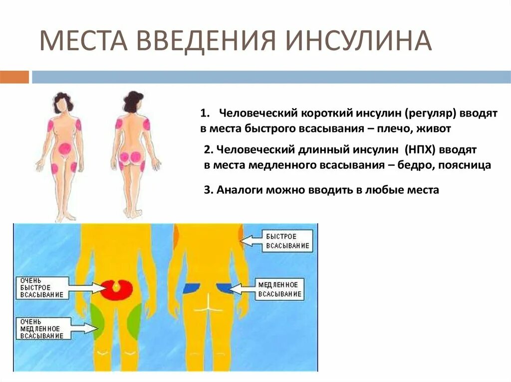 Введение инсулина при сахарном диабете. Сахарный диабет 1 типа техника инъекций инсулина. Места инъекций. Места введения инсулина. Места введения инсулина при сахарном диабете 1. Техника введения длинного инсулина.