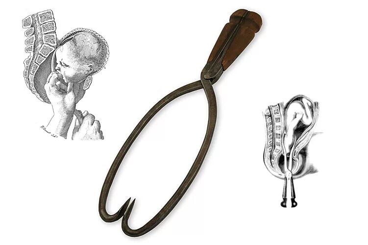 Инструментарий для прерывания беременности. Инструменты для арбортв. Старинные инструменты для аборта.