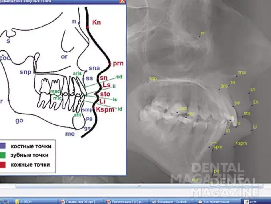Телерентгенограмма черепа (ТРГ). Точка sna на ТРГ. Зубные антропометрические точки черепа ТРГ. Точка 1.0 старая версия