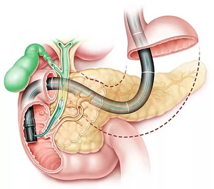Удаление воздуха из желудка. ЭРХПГ поджелудочной железы. Эндоскопическая ретроградная холангиопанкреатография. Ретроградная холангиопанкреатография ЭРХПГ. Эндоскопическая ретроградная холангиопанкреатография (ЭРХПГ).