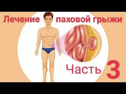 Паховая грыжа у мужчин операция