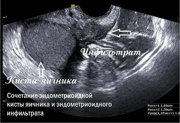 Узи признаки эндометриоза матки. Ретроцервикальный эндометриоз на УЗИ. Ретроцервикальный инфильтрат. Ретроцервикальный эндометриоз симптомы. Ретроцервикальный эндометриоз снимки УЗИ.