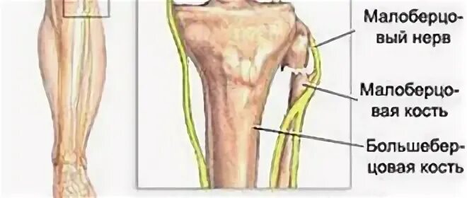 Нейропатия малоберцового нерва. Невропатия (неврит) малоберцового нерва. Неврома малоберцового нерва. Нейропатия малоберцового нерва нерва.