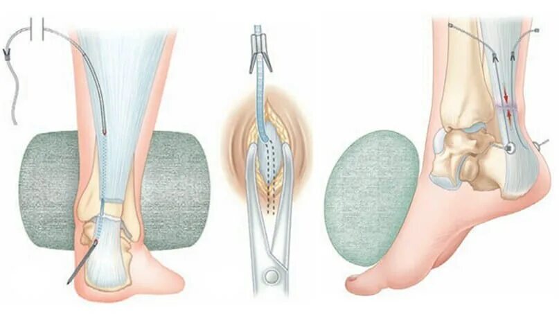 Пластика ахиллова сухожилия. Операция сшивания ахиллова сухожилия. Операция на ахиллово сухожилие. Транскутанный шов ахиллова сухожилия.