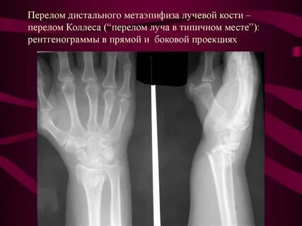 Закрытый перелом кости без смещения мкб