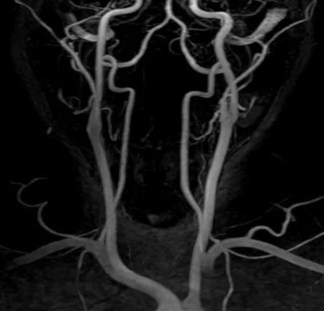 МР-ангиография артерий шеи. Магнитно-резонансная ангиография сосудов шеи. Мрт ангиография артерий шеи.