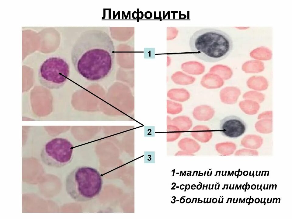 Лимфоциты мазок крови. Малый лимфоцит и большой лимфоцит. Лимфоциты и моноциты гистология. Широкоплазменные лимфоциты. Размер лимфоцитов